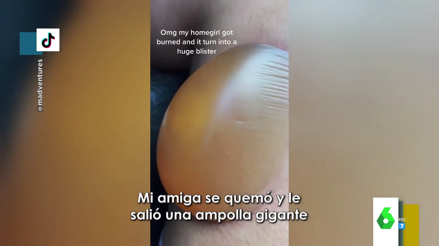 El impactante vídeo de una ampolla enorme: "Os recomiendo que cerréis los ojos" El impactante vídeo de una ampolla enorme: "Os recomiendo que cerréis los ojos"