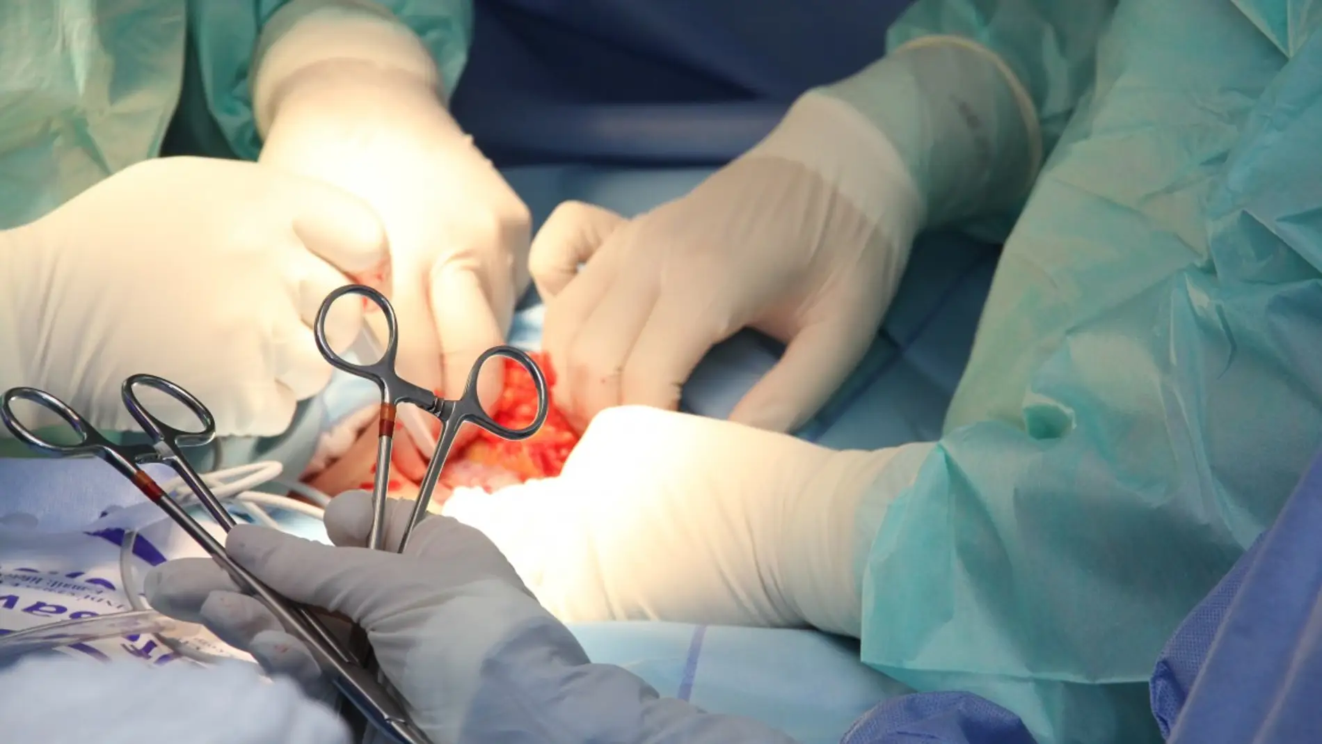 Una operación de transplante de órganos en un quirófano