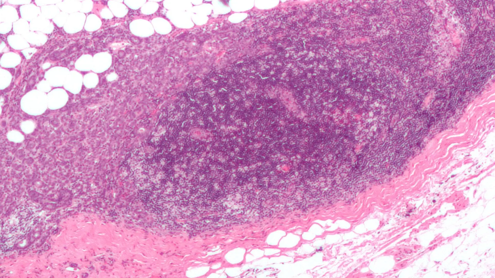 ganglio linfático invadido por un carcinoma ductal de mama