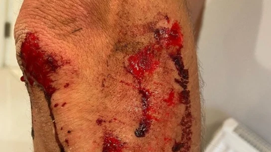 Así quedó la pierna de Alexandar Richardson tras un ataque con machete Así quedó la pierna de Alexandar Richardson tras un ataque con machete