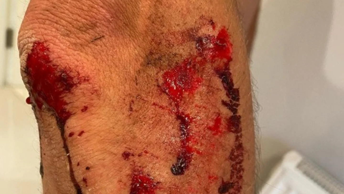 Así quedó la pierna de Alexandar Richardson tras un ataque con machete Así quedó la pierna de Alexandar Richardson tras un ataque con machete
