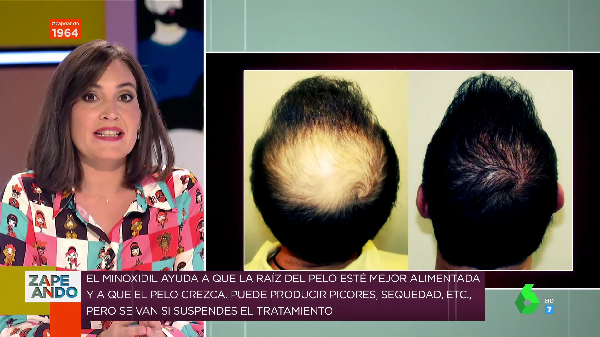 Sí, existe: Boticaria García explica cuál es el tratamiento más efectivo para evitar la caída del pelo