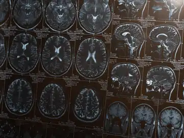Resonancia magnética de un cerebro Resonancia magnética de un cerebro