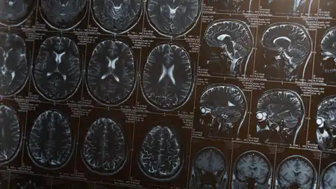 Resonancia magnética de un cerebro Resonancia magnética de un cerebro