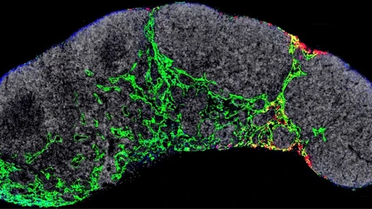Nuevo avance contra el cáncer: Investigadores españoles descubren una forma de frenar la metástasis del melanoma Nuevo avance contra el cáncer: Investigadores españoles descubren una forma de frenar la metástasis del melanoma
