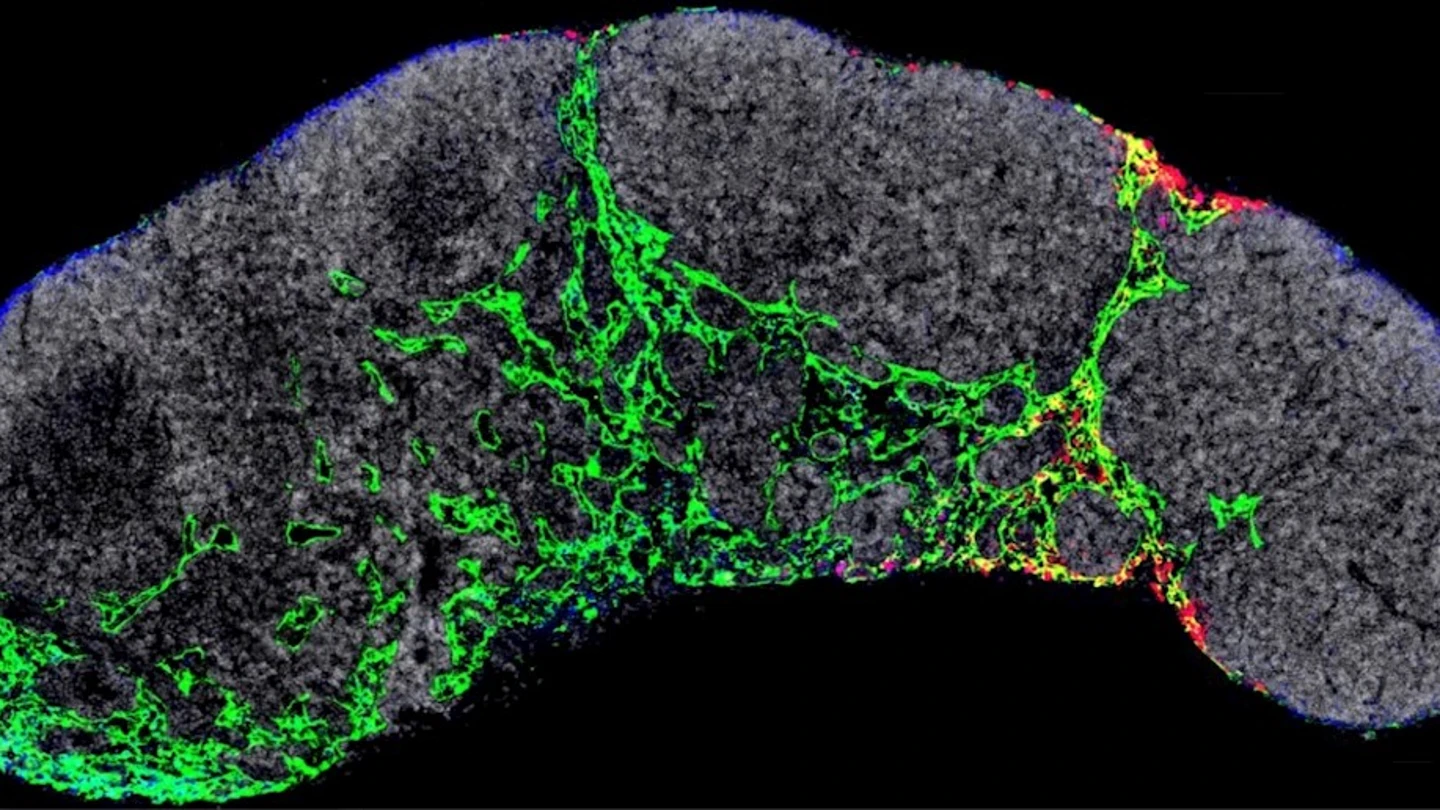 Nuevo avance contra el cáncer: Investigadores españoles descubren una forma de frenar la metástasis del melanoma Nuevo avance contra el cáncer: Investigadores españoles descubren una forma de frenar la metástasis del melanoma