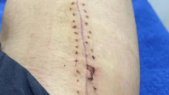 Cicatriz de Sergi Roberto Cicatriz de Sergi Roberto