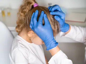 Piojos en niños Piojos en niños