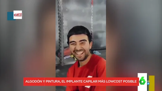 El curioso método de un mejicano para acabar con el problema económico del implante capilar El curioso método de un mejicano para acabar con el problema económico del implante capilar