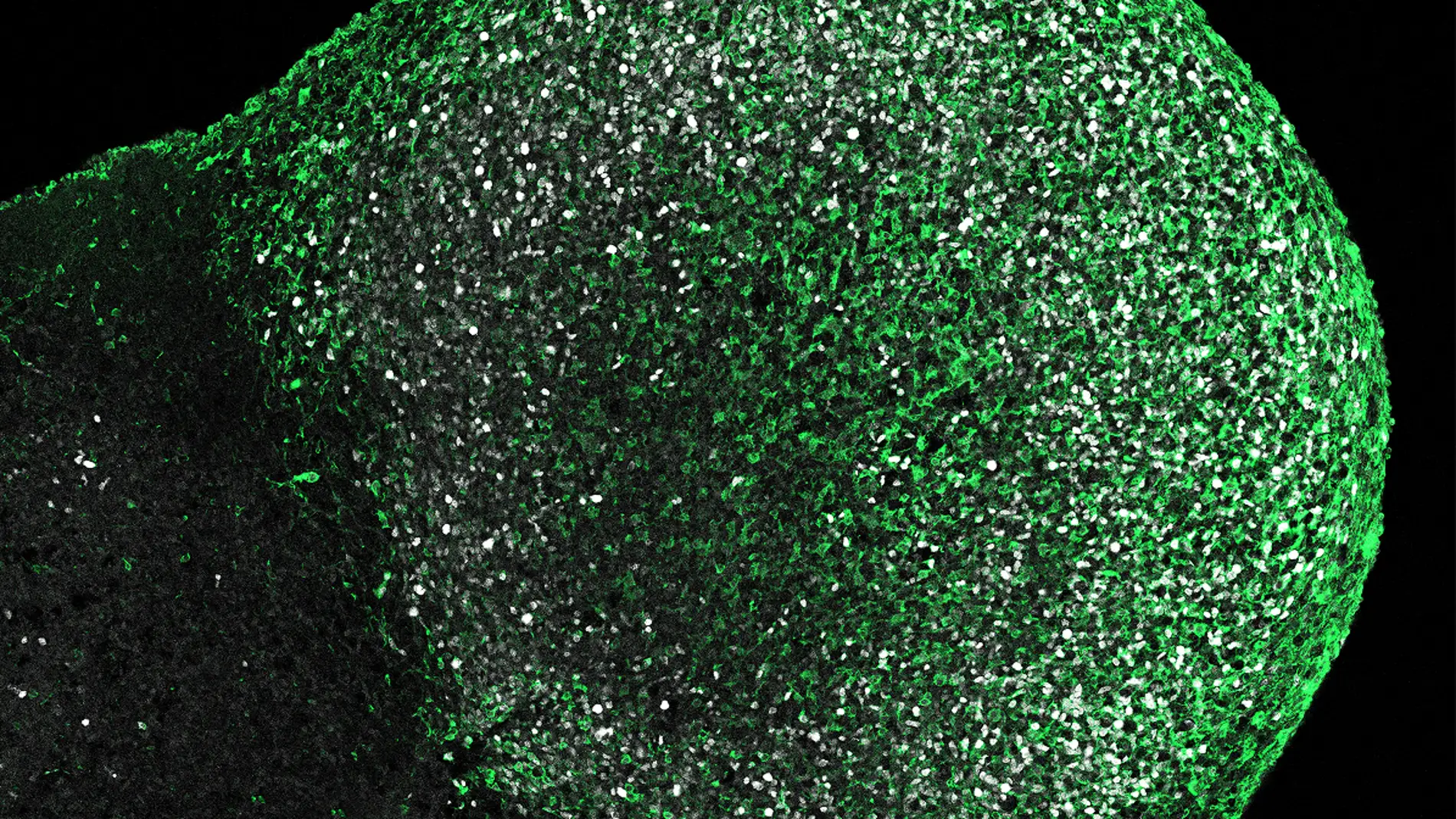 Organoide derivado de un paciente con esclerosis tuberosa