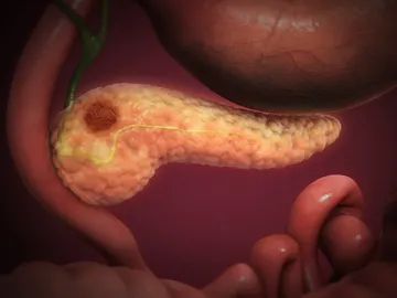 cáncer de páncreas cáncer de páncreas
