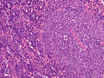 Descubierto un gen causante de la leucemia linfocitica cronica