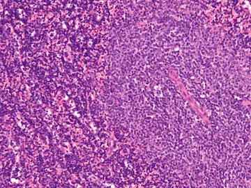 Descubierto un gen causante de la leucemia linfocitica cronica Descubierto un gen causante de la leucemia linfocitica cronica