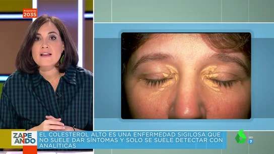 Boticaria García desvela el único síntoma del colesterol alto: así son las 'manchas' en párpados o tendones Boticaria García desvela el único síntoma del colesterol alto: así son las 'manchas' en párpados o tendones