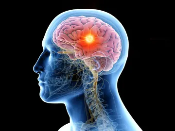 Ilustración de un tumor cerebral Ilustración de un tumor cerebral