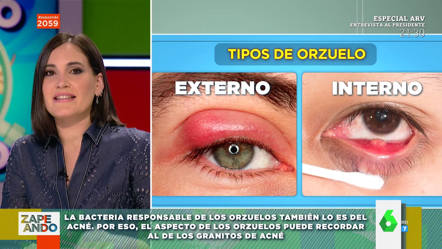 Por qué salen los orzuelos: Boticaria García explica cómo aparecen y el motivo por el que se parece al acné Por qué salen los orzuelos: Boticaria García explica cómo aparecen y el motivo por el que se parece al acné