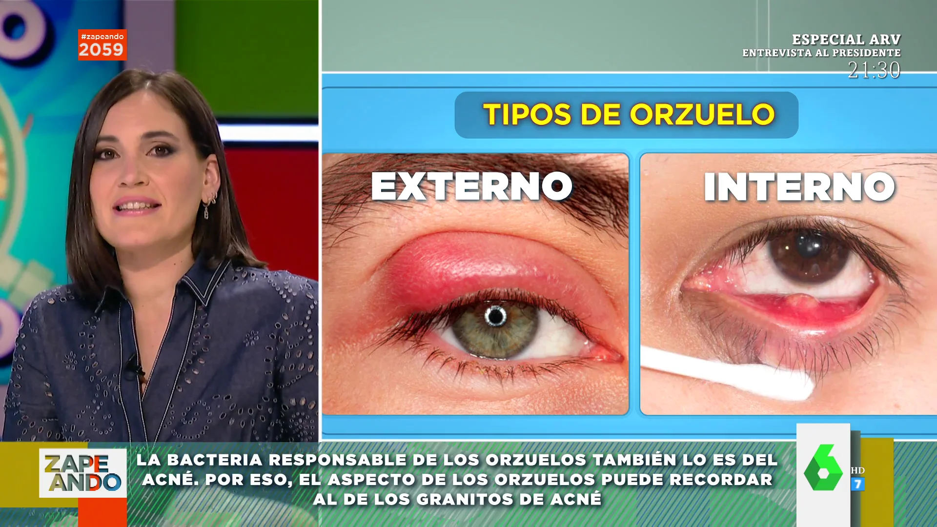 Por qué salen los orzuelos: Boticaria García explica cómo aparecen y el motivo por el que se parece al acné