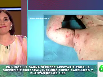 Ojo con los remedios caseros contra la sarna: Boticaria García explica qué tratamiento hay que aplicar