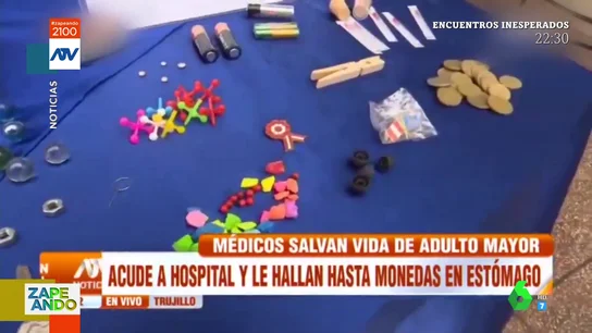 Llaves, monedas y hasta pinzas de la ropa: la sorprendente variedad de objetos que han extraído a niños en urgencias Llaves, monedas y hasta pinzas de la ropa: la sorprendente variedad de objetos que han extraído a niños en urgencias
