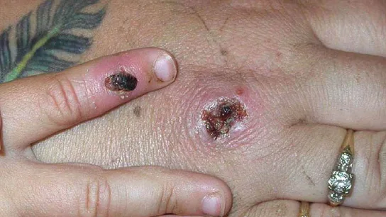 ¿Qué es el 'monkeypox'? Síntomas y transmisión de la 'viruela del mono' Alerta sanitaria