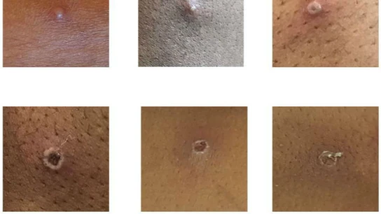 Detectados casos de 'viruela del mono' Detectados casos de 'viruela del mono'