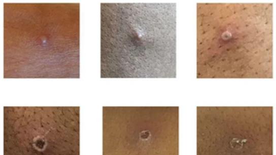 Erupciones y reacciones en la piel con la viruela del mono. Viruela del mono: qué es, cómo se transmite y cuáles son los síntomas