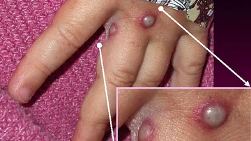¿Qué es el 'monkeypox'? Síntomas y transmisión de la 'viruela del mono'