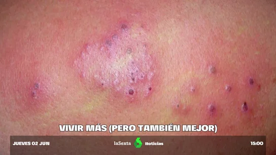 No es solo vivir más, sino hacerlo mejor: así podemos reforzarnos frente a enfermedades como el herpes zóster No es solo vivir más, sino hacerlo mejor: así podemos reforzarnos frente a enfermedades como el herpes zóster