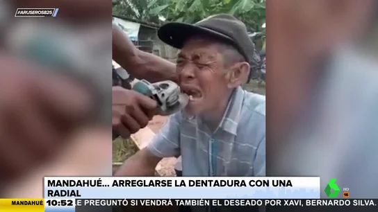 Dientes radial Dientes radial