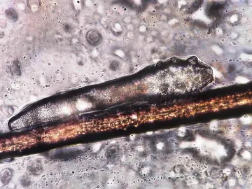 Ácaro Demodex Ácaro Demodex