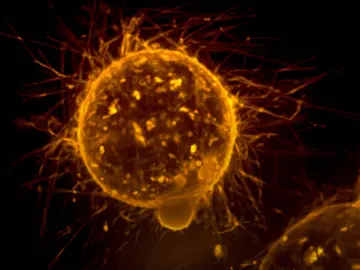 Metástasis Metástasis