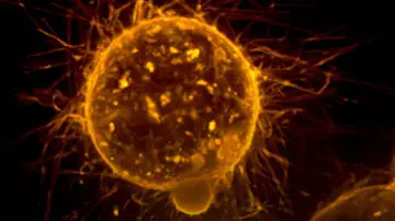 Metástasis Metástasis