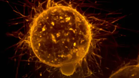 Metástasis Metástasis