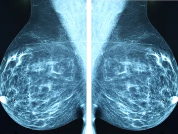 Mamografía para detectar el cáncer de mama Mamografía para detectar el cáncer de mama
