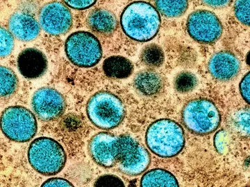 Virus de mpox visto en el microscopio Virus de mpox visto en el microscopio