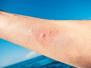 Cómo tratar la picadura de una medusa Cómo tratar la picadura de una medusa