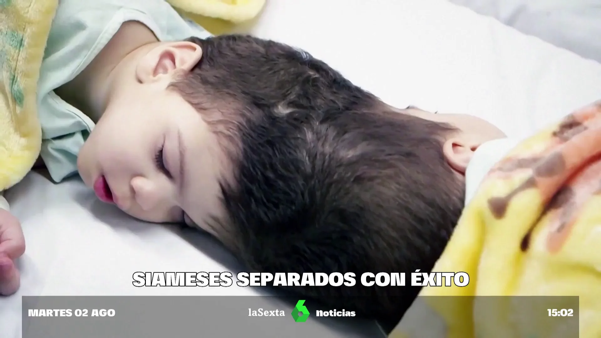 Separan a dos gemelos siameses de tres años que compartían cerebro tras siete cirugías Separan a dos gemelos siameses de tres años que compartían cerebro tras siete cirugías