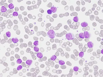 leucemia leucemia
