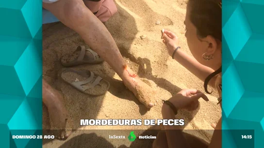Mordedura de un pez en una playa de Girona Mordedura de un pez en una playa de Girona