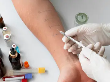 Prueba de la alergia Prueba de la alergia