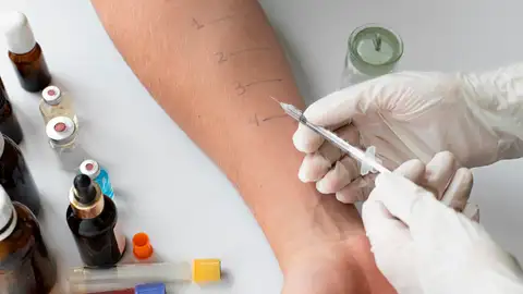 Prueba de la alergia Prueba de la alergia