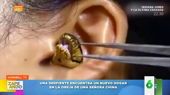 Así sacan una serpiente de la oreja de una mujer Así sacan una serpiente de la oreja de una mujer