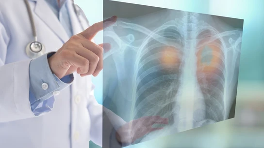 Cómo detectar de forma precoz el cáncer de pulmón, el tumor que más muertes provoca en España Cómo detectar de forma precoz el cáncer de pulmón, el tumor que más muertes provoca en España