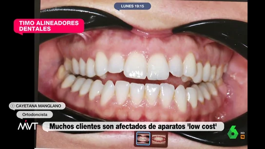 El timo de los alineadores dentales: "Cuando bostezaba se me enganchaba la mandíbula" El timo de los alineadores dentales: "Cuando bostezaba se me enganchaba la mandíbula"