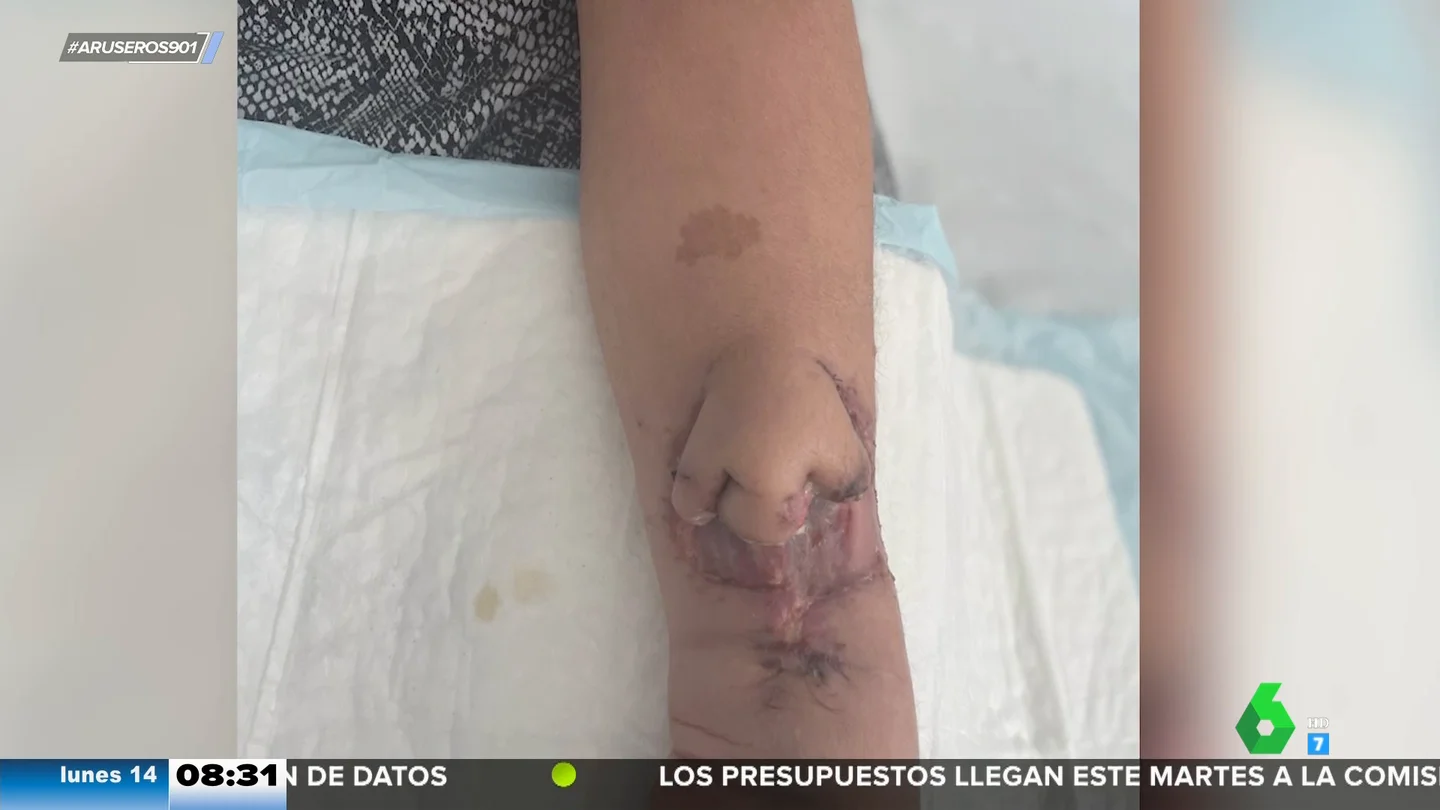 Injertan una nariz artificial a una paciente tras hacerla crecer en su brazo Injertan una nariz artificial a una paciente tras hacerla crecer en su brazo