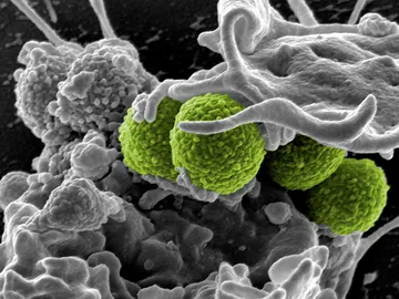 infección bacteriana por S. aureus infección bacteriana por S. aureus