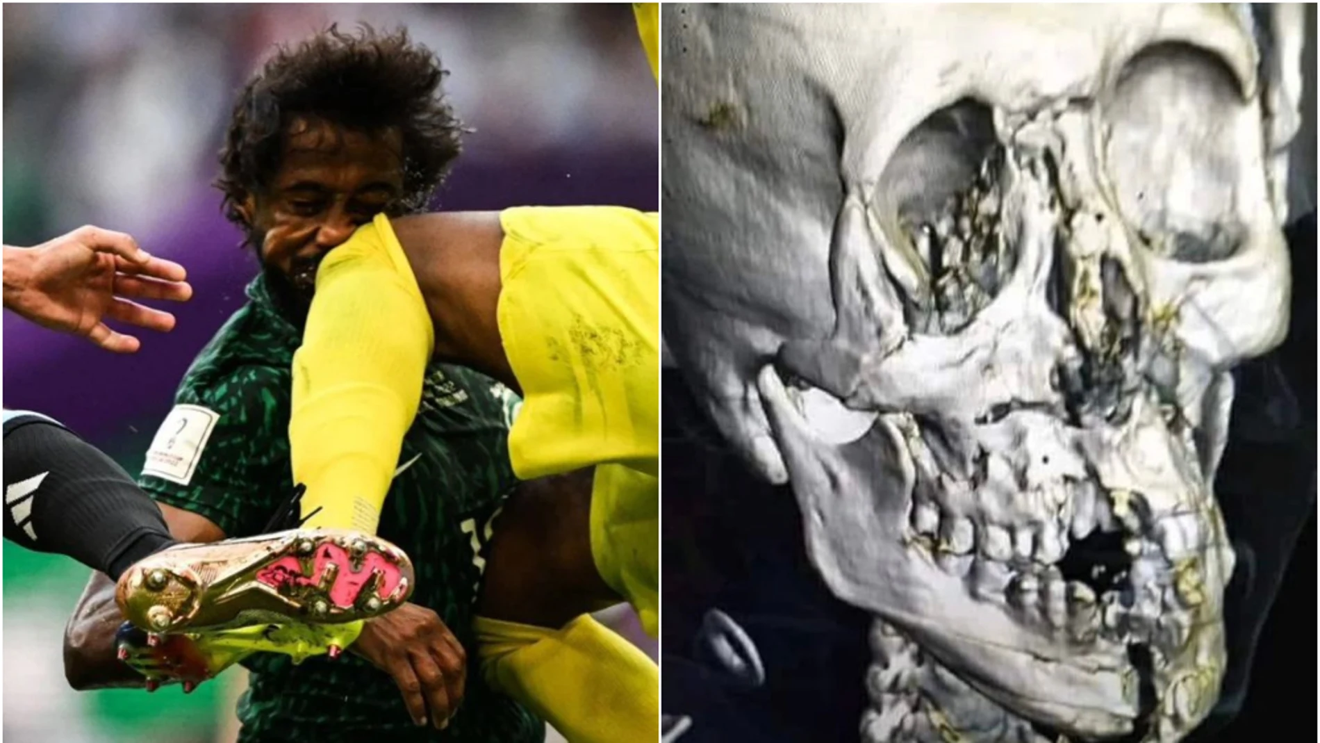 La escalofriante radiografía del cráneo del saudí Al-Shahrani tras su fractura contra Argentina