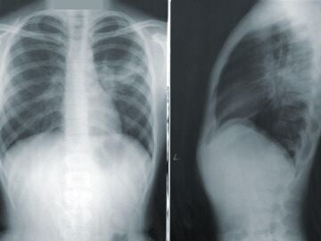Radiografía de un torso