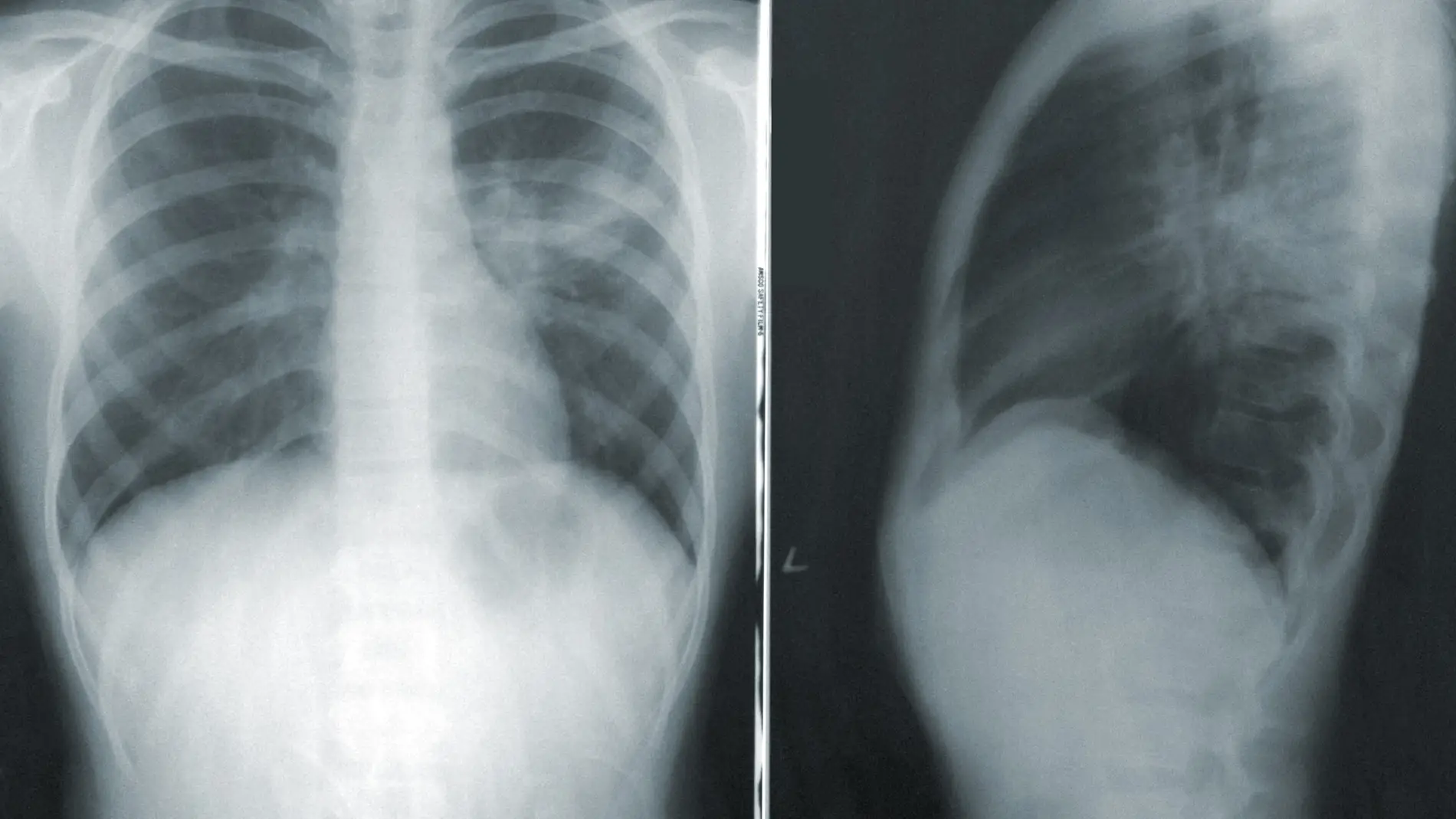 Radiografía de un torso