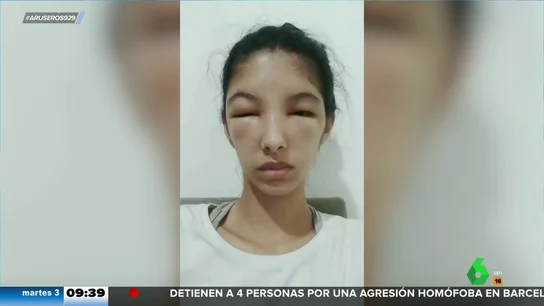 Una joven sufre una reacción alérgica tras teñirse el pelo en casa Una joven sufre una reacción alérgica tras teñirse el pelo en casa